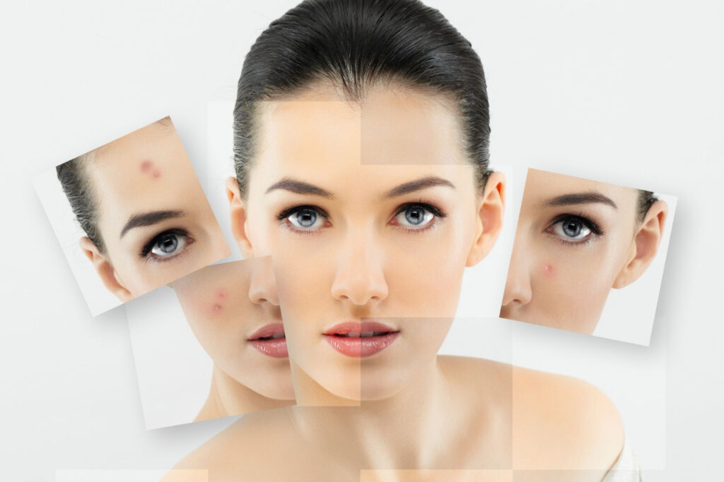 Acne Treatment by Dr. SR Vaid in Lucknow