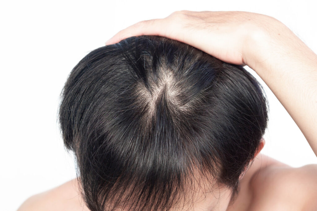 hair loss treatment in lucknow