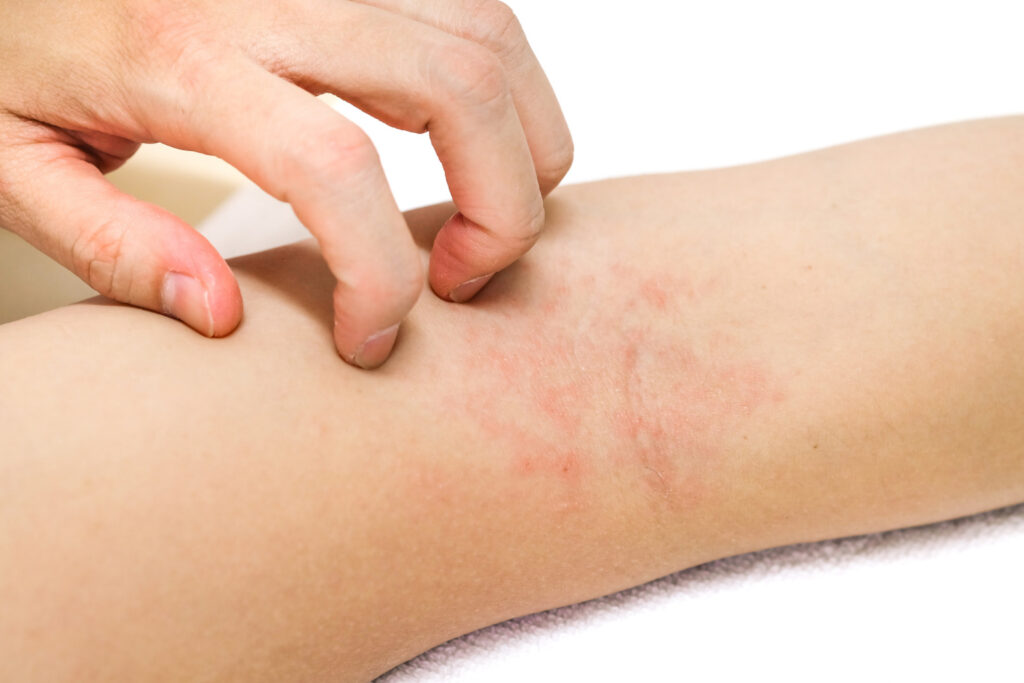 Psoriasis Treatment by Dr. SR Vaid in Lucknow