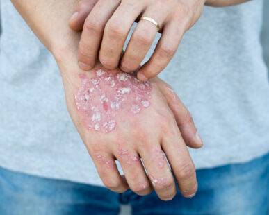 Dr. S. R. Vaid's Expert Ayurvedic Treatment for Psoriasis