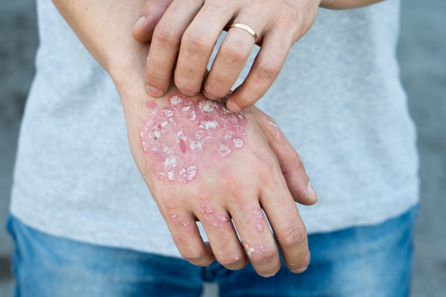 Dr. S. R. Vaid's Expert Ayurvedic Treatment for Psoriasis